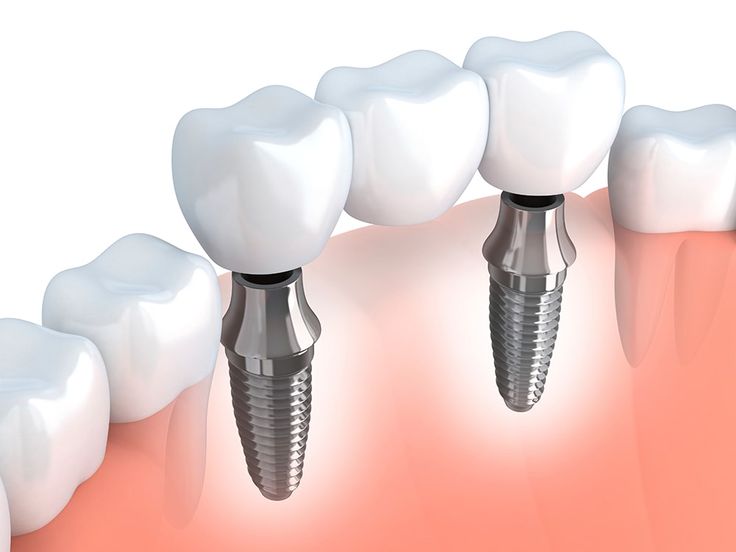 dental bridge image