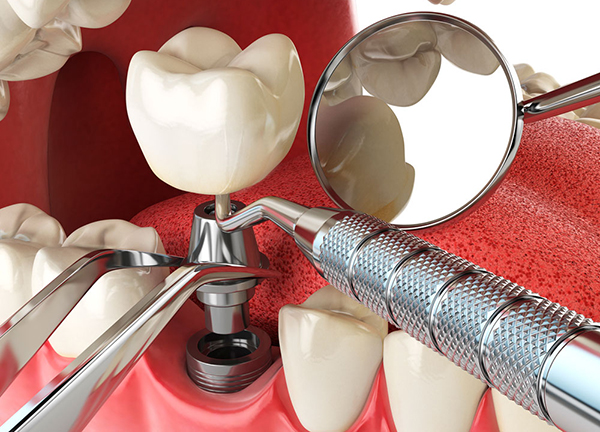 dental implants image