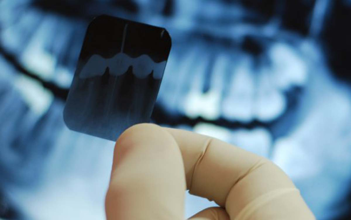 dental inlays image