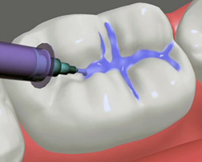 dental sealants image